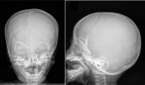 Figure 6 From Diagnostic Features Of Prematurely Fused Cranial Sutures