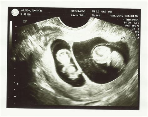 What an emotional 9 week ultrasound! 9 Weeks Pregnant with Twins: Tips, Advice & How to Prep ...