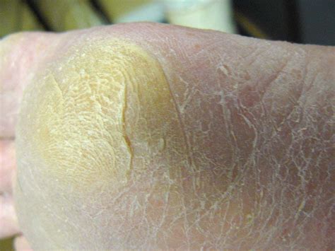 Skin Peeling On Bottom Of Feet