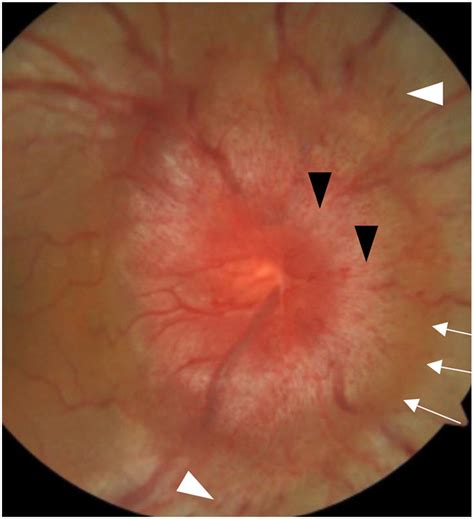 Approach To Patient With Unilateral Optic Disc Edema And Normal Visual