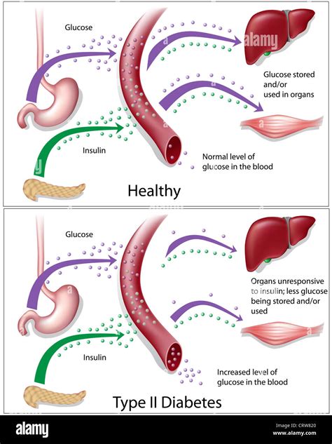 Diagram Illustrating Type 2 Diabetes Versus Healthy Blood Glucose Stock