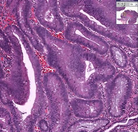 Washingtondeceit Histopathology Colon Tubular Adenoma Adenomatous Polyp