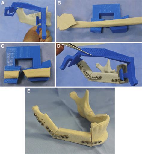 Model Surgery A The Printed Mandibular Cutting Guide Is Fitted To The