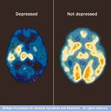Depression Brain