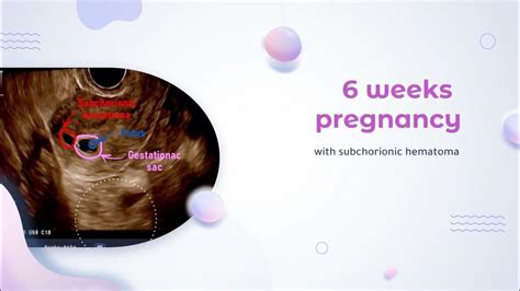 6 Weeks Pregnancy With Subchorionic Hematoma Youtube