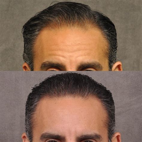 Hair Transplant And Hairline Lowering Before And Afters Beverly Hills