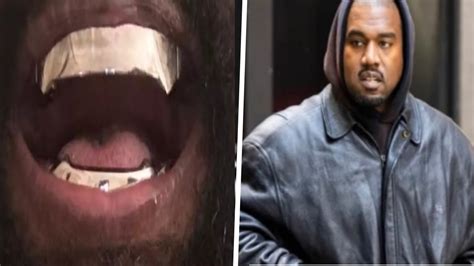Kanye Wests Titanium Dentures Worth 850000 Are Considered
