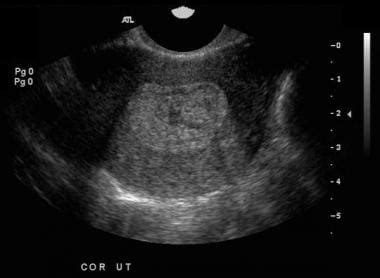 Imaging In Pelvic Inflammatory Disease And Tubo Ovarian Abscess