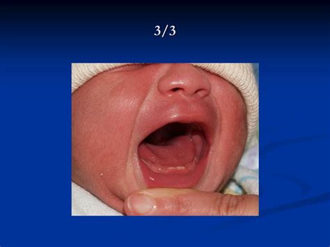 Ppt Common Newborn Findings Powerpoint Presentation Free Download