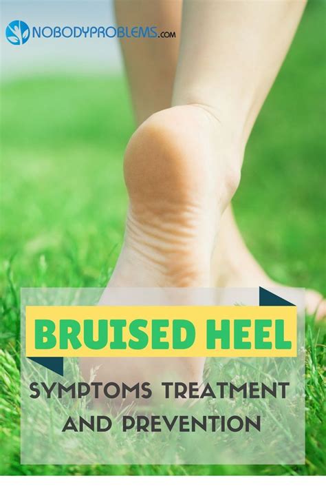 How To Treat A Bruised Heel Properly Steventon