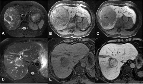 Hepatocellular Carcinoma State Of The Art Imaging And Recent Advances