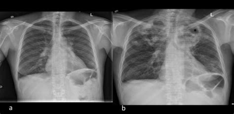 A Chest X Ray Demonstrating Calcification In The Hilum 2b Large Bi