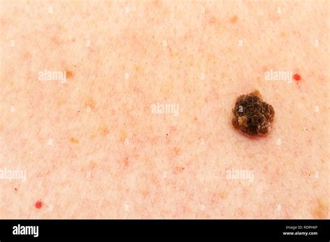 Seborrheic Keratosis High Resolution Stock Photography And Images Alamy