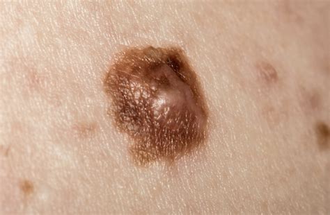 Cancerous Moles Images Symptoms And Pictures