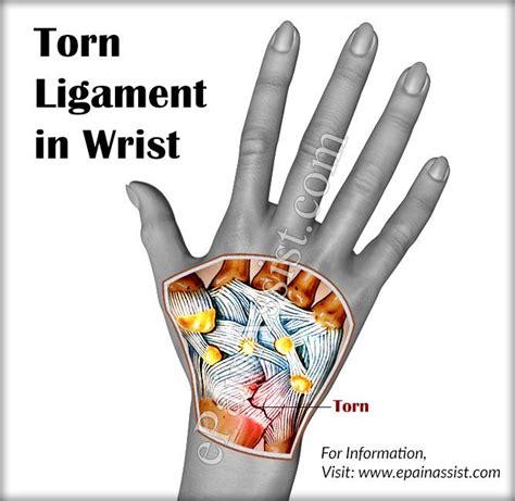 Torn Ligament In Wrist Ligament Tear Wrist Injury Sprained Wrist