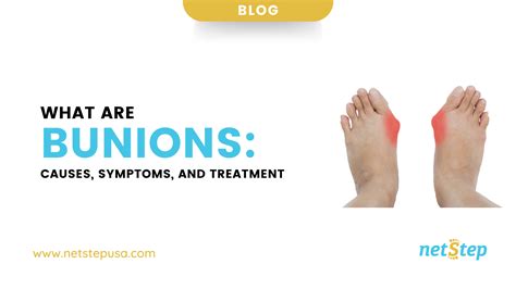 What Are Bunions Causes Symptoms And Treatment Netstep
