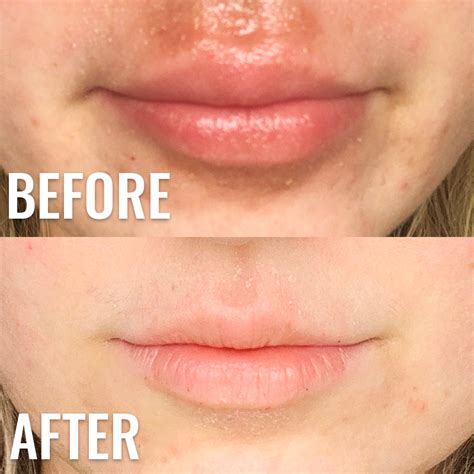 How I Cured My Lip Rash Cheilitis Eczema Contact Dermatitis Once
