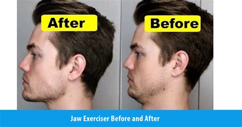 Jaw Exerciser Before And After Jawflex