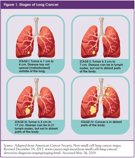 Stage 4 Lung Cancer