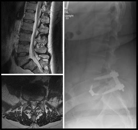 Anterior Lumbar Interbody Fusion For Chronic Low Back Pain Due To L S