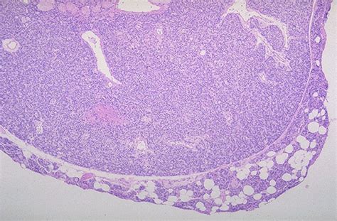 Pathology Outlines Parathyroid Adenoma