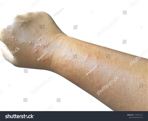 Close Woman Has Rashes Blisters Allergy Stock Photo 1193073115