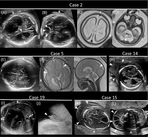 Fetal Imaging Studies Of Five Individuals With Pathogenic Or Candidate