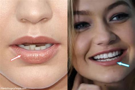 does gigi hadid have cosmetic surgery before and after pics