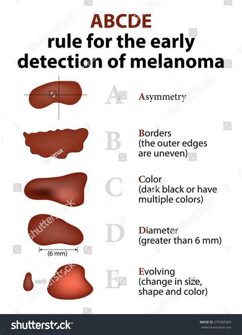 Abcde Rule Of Skin Cancer Detection