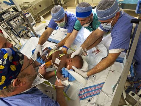 Medical Miracle Conjoined Twins Separated In Memphis Photo 1 Cbs News