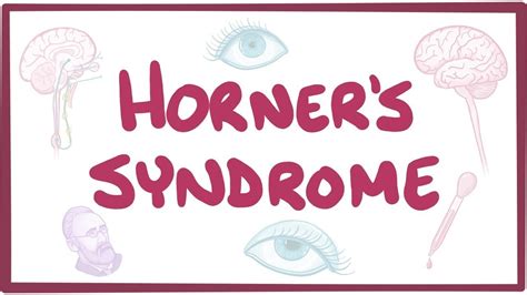 Horner S Syndrome Causes Symptoms Diagnosis Treatment Pathology