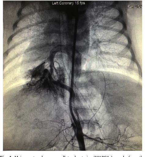 Figure 1 From Surgical Ductal Stent Implantation In Total Anomalous