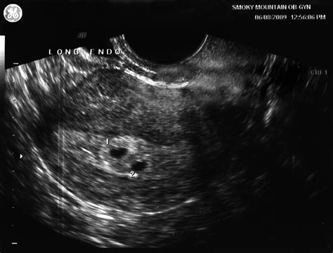Taken at 4 weeks, the ultrasound image shows a gestational sac. The Adventures (and misadventures) of One Twin Mama: Twins ...