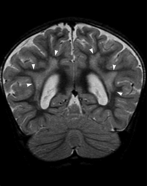 Brain Magnetic Resonance Imaging Findings In 49xxxxy Syndrome Pediatric Neurology