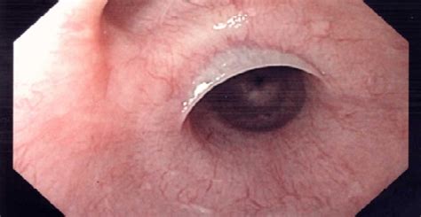 Iron deficiency anemia, esophageal webs, and dysphagia (difficulty swallowing). PLAB Exam Practice Questions: Quiz 119 - medicalkidunya