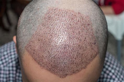 Facts And Myths Of Hair Transplant Surgery Glc Aesthetics