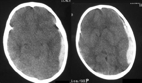 Large Acute Subdural Haematoma Over Left Temporo Parieto Occipital