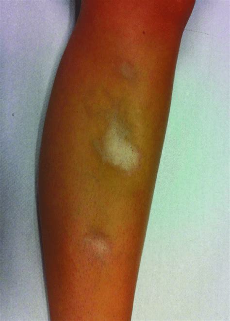 Atrophy And Depigmentation Around The Injection Sites Five Months After