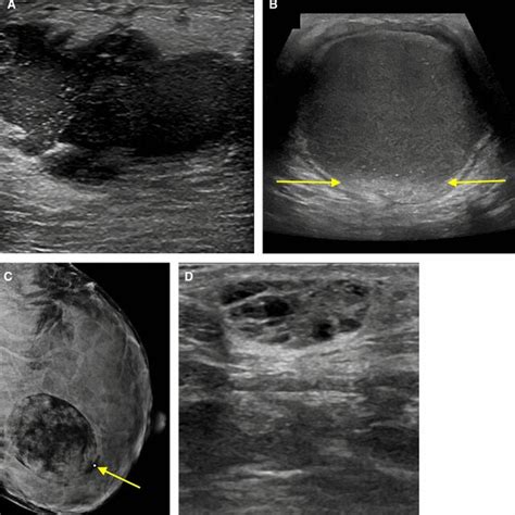Us Appearance Of Lactating Breast Sonographic Evaluation In A