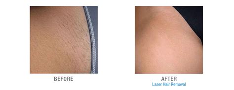 Best Home Laser Hair Removal For Brazilian Beauty Health