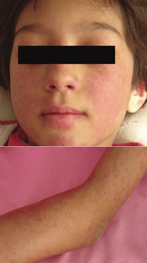 Generalized Erythematous Maculopapular Rash Of The Patient