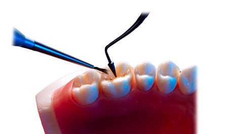 Direct Posterior Restorations Simplifying Occlusal Surface And Bonding