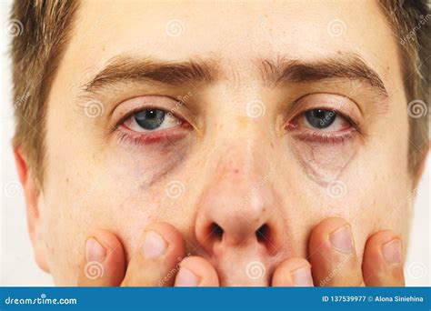 Conjunctivitis Tired Eyes Red Eyes Eye Disease Stock Image Image