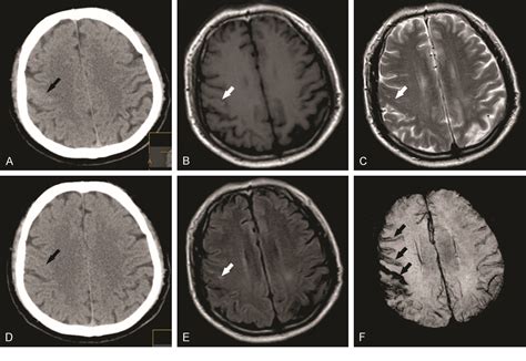 Figure 1 From Transient Ischemic Attack As Initial Presentation Of