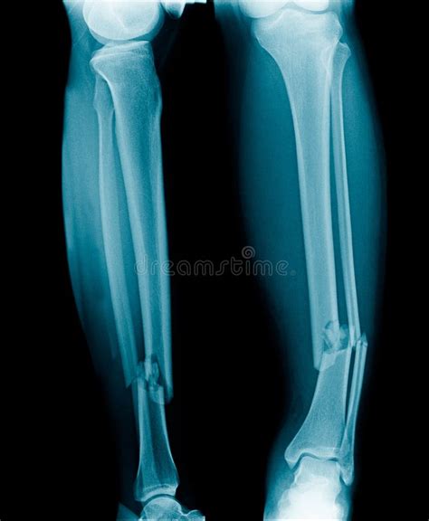 X Ray Fracture Leg Stock Image Image Of Body Medical 123039597