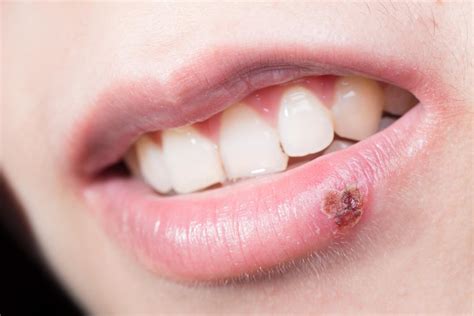 How To Get Rid Of A Cold Sore Scab Core Plastic Surgery
