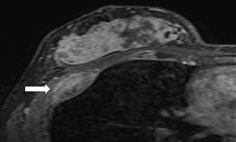 A 31 Year Old Female With Rib Metastasis Showing Extraosseous Soft