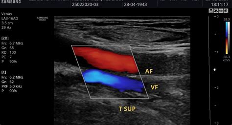 Ultrasonido Doppler Arterial Venoso Dr Emmanuel Acu A Hot Sex Picture