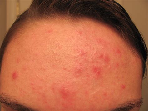 Severe Moderate Or Mild Acne General Acne Discussion Forum