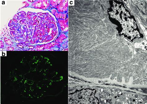 Pathology Of Immunotactoid Glomerulopathy A The Glomerulus Shows